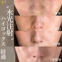 水光注射ハイコックス(ジャルプロクラシック) before画像 サムネイル用