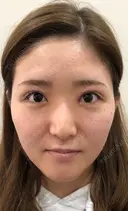 目頭切開（W法）、眼瞼下垂タッキング 10日後 サムネイル用