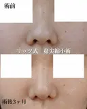 鼻尖縮小 after画像 サムネイル用