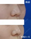 鼻尖縮小 after画像 サムネイル用