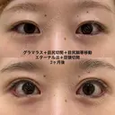 たれ目形成 after画像 サムネイル用