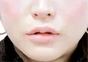 竹内式M字型リップ形成手術 after画像 サムネイル用