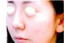 鼻中隔延長術 before画像 サムネイル用