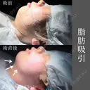 脂肪をなくす🦋！ ネビュラクリニックの脂肪吸引💎 after画像 サムネイル用