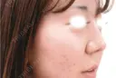 鼻中隔延長術 after画像 サムネイル用