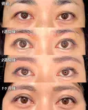 眉下切開 31日後 サムネイル用