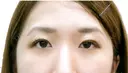 二重まぶた埋没法（竹内式埋没法） after画像 サムネイル用