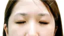 二重まぶた埋没法（竹内式埋没法） after画像 サムネイル用