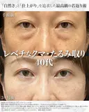【40代/クマ治療】目の下の切らないクマ取り （脂肪注入併用） before画像 サムネイル用