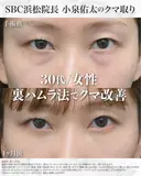 【30代/クマ治療】裏ハムラ法 before画像 サムネイル用