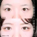 目頭切開+二重埋没法（選べるオーダーメイド） after画像 サムネイル用