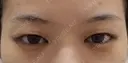二重埋没 before画像 サムネイル用