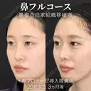 鼻フルコース（鼻複合自家組織移植術）＋鼻プロテーゼ挿入隆鼻術 90日後 サムネイル用
