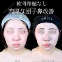 小鼻縮小/鼻翼軟骨トリム/フラップ固定 /鼻尖形成/鼻孔縁挙上 90日後 サムネイル用