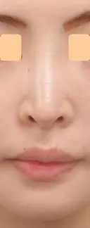 人工真皮Sure Derm挿入矢印鼻･魔女鼻改善術 before画像 サムネイル用