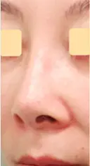 人工真皮SureDerm挿入隆鼻術 before画像 サムネイル用