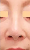 人工真皮SureDerm挿入隆鼻術 after画像 サムネイル用