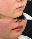 Cカールリップ（ボルベラ） before画像 サムネイル用