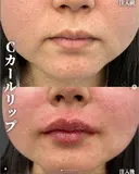 Cカールリップ（ボルベラ） after画像 サムネイル用