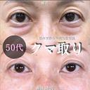 切らない目の下のクマ取り/余剰皮膚切除/脂肪注入（目の上・目の下・ゴルゴライン） 90日後 サムネイル用