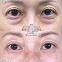 切らない目の下のクマ取り/余剰皮膚切除/脂肪注入（目の上・目の下・ゴルゴライン） before画像 サムネイル用