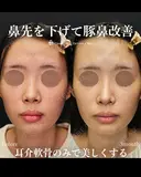 鼻先を下げて豚鼻改善 90日後 サムネイル用