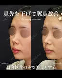 鼻先を下げて豚鼻改善 90日後 サムネイル用