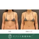 バストの輪郭をより綺麗に👙豊胸術（脂肪注入）＋コンプリート脂肪吸引（腹部全体） after画像 サムネイル用
