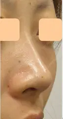 隆鼻術(脂肪注入) before画像 サムネイル用