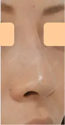隆鼻術(脂肪注入) after画像 サムネイル用