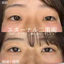 エターナル二重術 before画像 サムネイル用