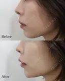 Eライン形成 before画像 サムネイル用