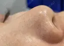 ハイドラジェントル before画像 サムネイル用