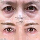 切らない目の下のクマ取り/余剰皮膚切除/脂肪注入（目の下・ゴルゴライン） before画像 サムネイル用