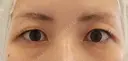 二重埋没 before画像 サムネイル用