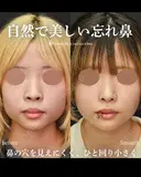 自然で美しい忘れ鼻 150日後 サムネイル用