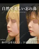 自然で美しい忘れ鼻 150日後 サムネイル用