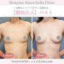 脂肪注入【バスト】 after画像 サムネイル用