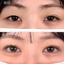 二重埋没法＋ まぶたの脂肪取り ＋目頭切開 before画像 サムネイル用