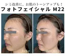 フォトフェイシャル M22・ステラM22（IPL） after画像 サムネイル用