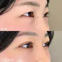 二重埋没法＋ まぶたの脂肪取り＋ 切らない目の下のクマ取り・目の下のたるみ（ふくらみ）取り after画像 サムネイル用