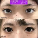 目頭切開 after画像 サムネイル用