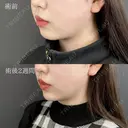 顔の脂肪吸引 +切らない顎形成 3D Eライン+ 顎（あご）のヒアルロン酸注射+ 小顔美肌再生（リフトアップ） after画像 サムネイル用