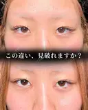 目頭切開 7日後 サムネイル用