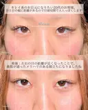 目頭切開 7日後 サムネイル用