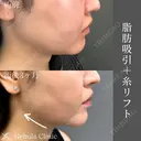 顔の余白を消す🦋 ネビュラクリニックの脂肪吸引＋糸リフト🪡 after画像 サムネイル用