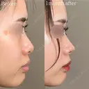 鼻尖形成 after画像 サムネイル用