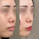 鼻尖形成 before画像 サムネイル用