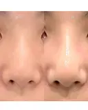 鼻尖形成＋TCBメッシュ after画像 サムネイル用