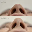 鼻尖形成＋切らない小鼻縮小（鼻翼縮小埋没法） after画像 サムネイル用